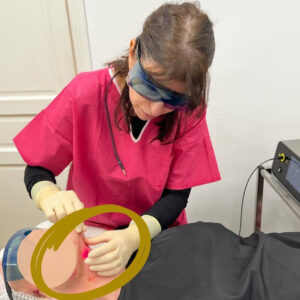 Endolift, intervention laser sur la peau du cou