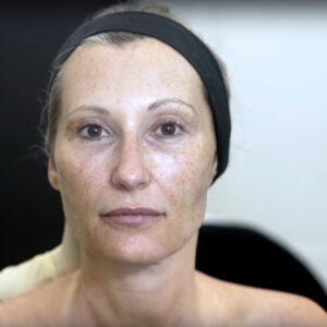 HArmonyCA : traitement de la peau du visage