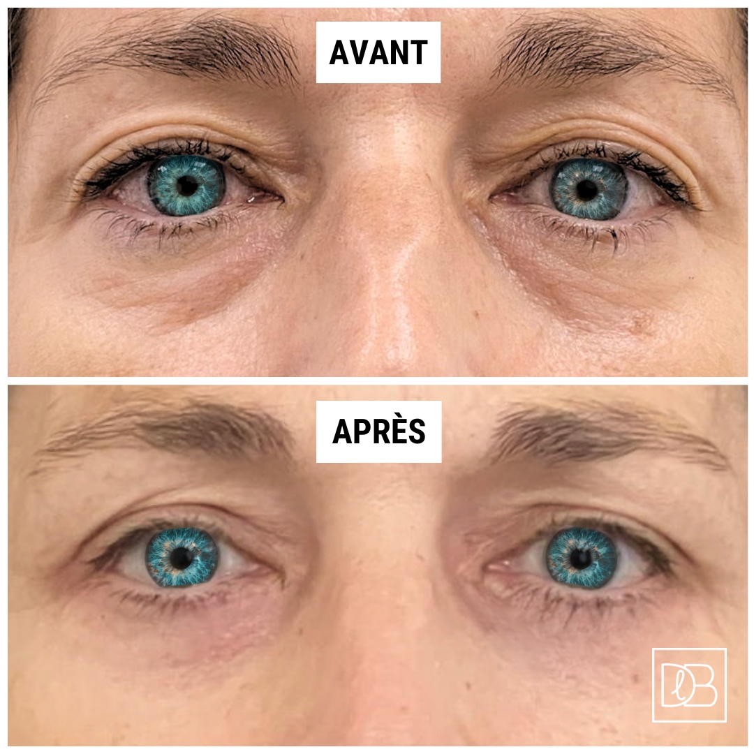 Avant après une blépharoplastie (DLB - Paris 7)