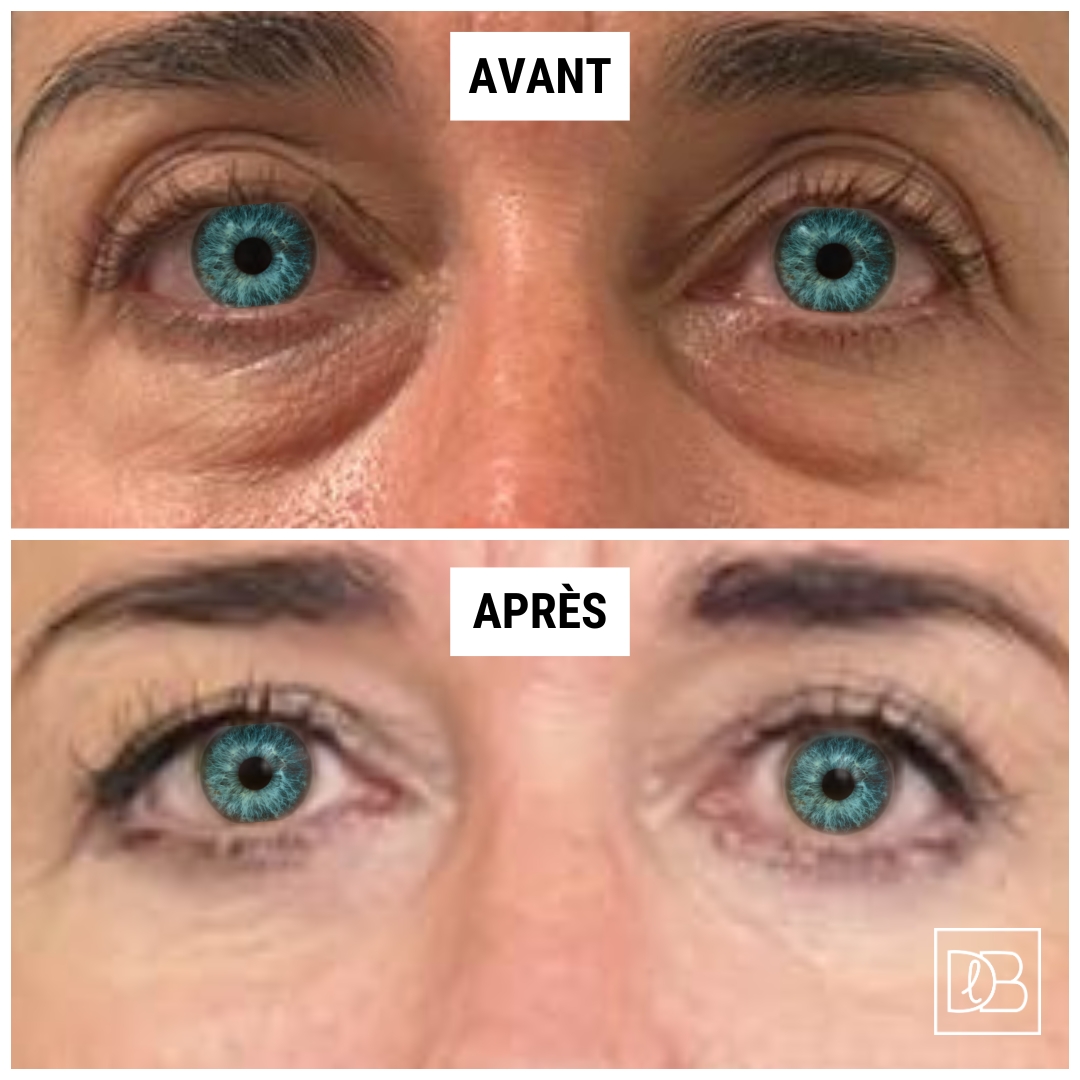 Avant après une blépharoplastie (Dr Benouaiche - Paris)