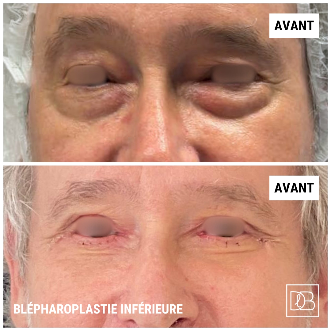 Blépharoplastie inferieure homme - Avant Après