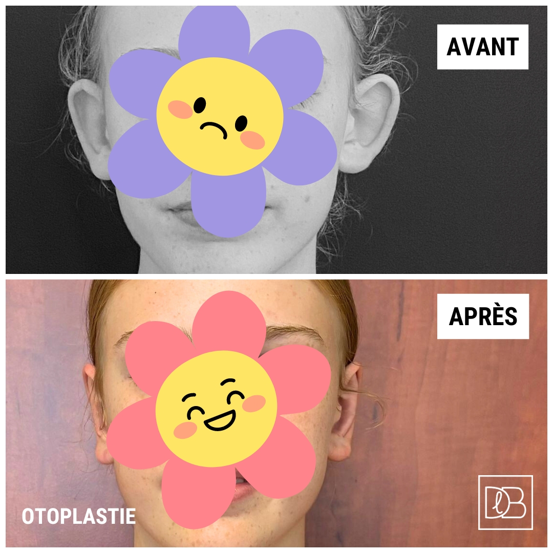 Avant après une otoplastie chez une jeune fille (Dr Benouaiche - Paris)