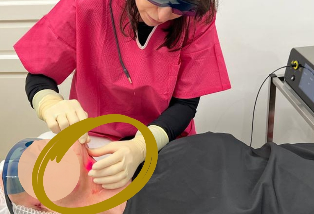 Endolift : laser sous-cutané